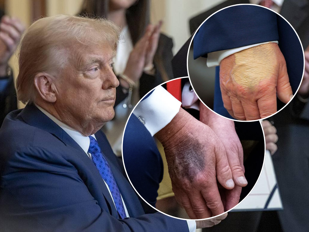 На руці Трампа помітили дивні плями. Білий дім дав пояснення